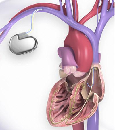 illustration of heart and ICD